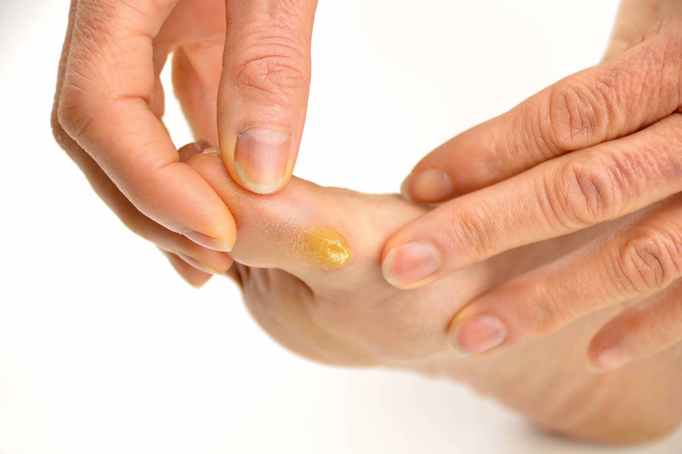 How Do You Get Rid Of Calluses Permanently? 