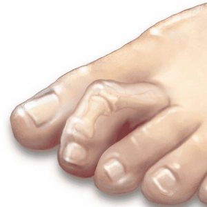 Hammer toes, claw toes, mallet toes treatment: hammer toes pictures before  and after