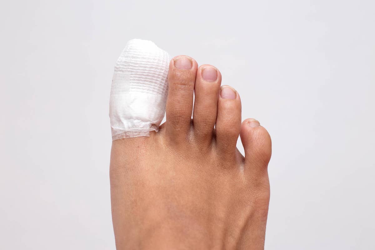 Treatment options for Ingrown Toenails - Active Care Podiatry