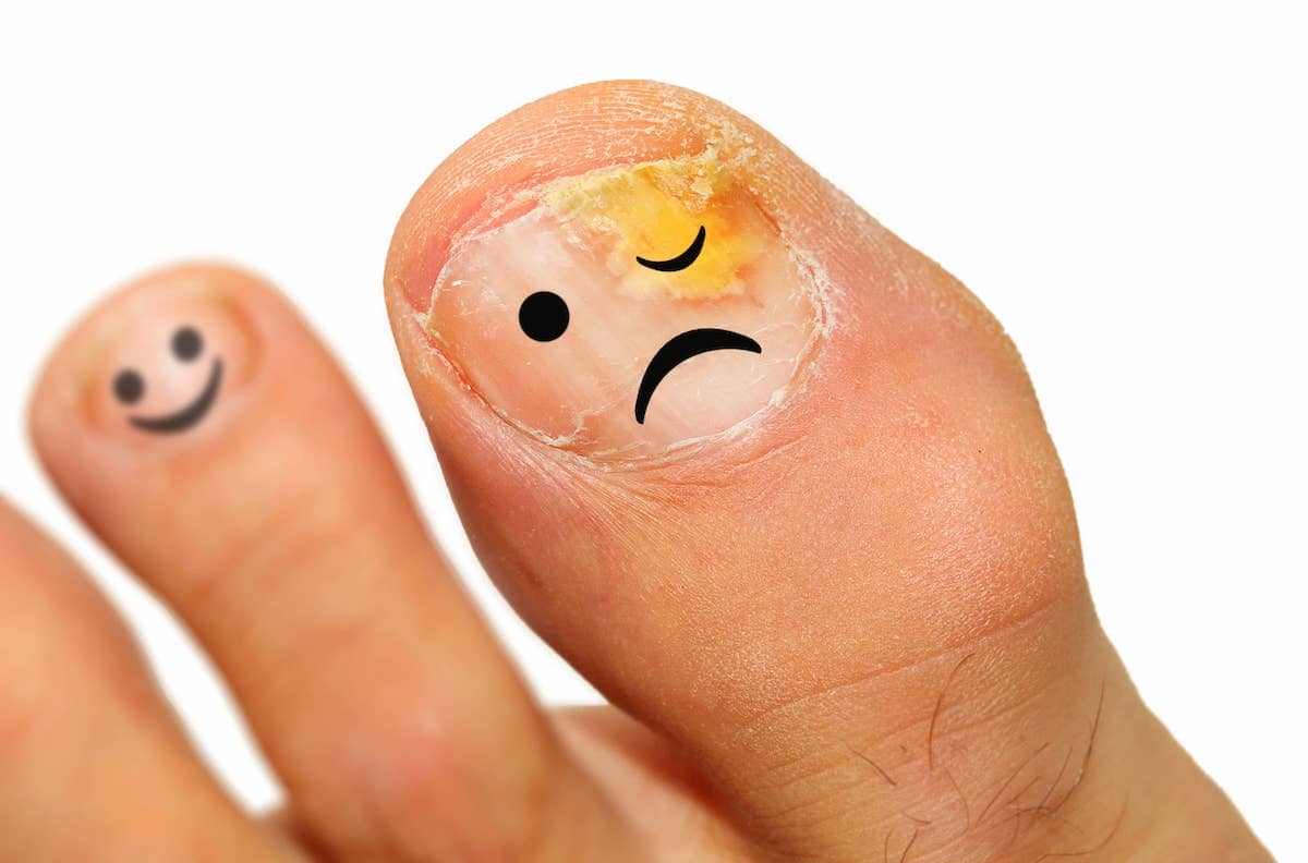 Tinea unguium effecting the toe nails. Diagnosis: Onychomycosis