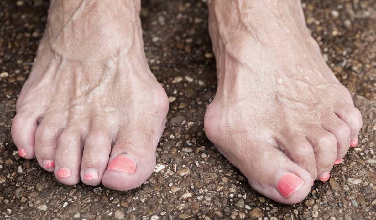 The Consequences of Hammertoe