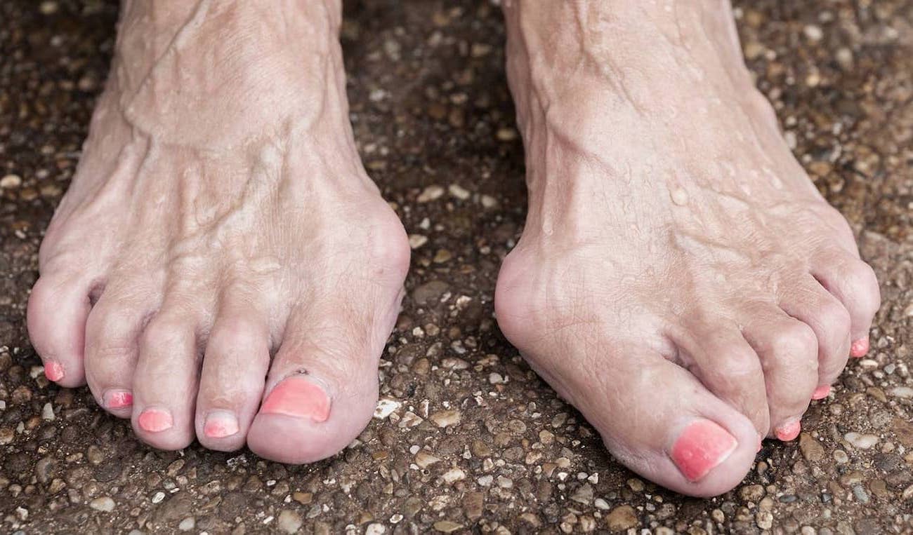 Hammertoe - Symptoms, Causes, Relief And Treatments