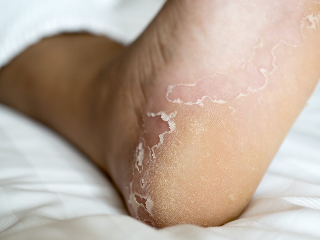 What Causes Itchy Feet 4 Common Causes Jaws Podiatry