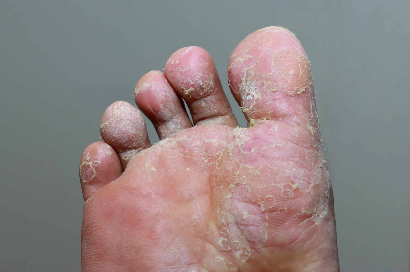 Signs of Disease Your Feet Can Reveal