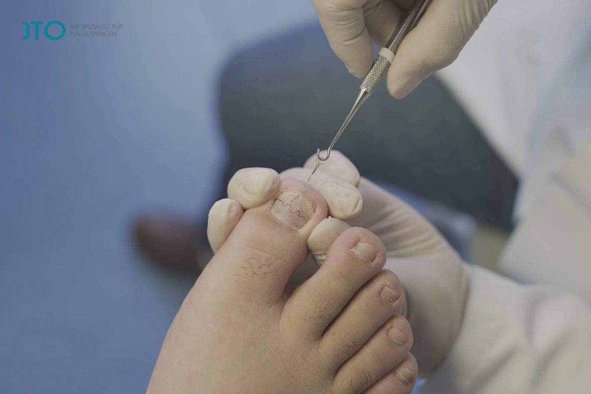 Ingrown Toenail Treatment | Ankle & Foot Centers of America