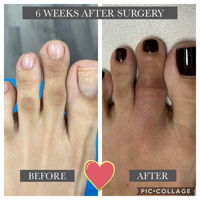 What Is Aesthetic Toe Shortening Surgery Jaws Podiatry
