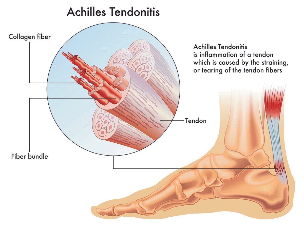 What type of doctor should I see for an injury to my Achilles tendon? -  Quora