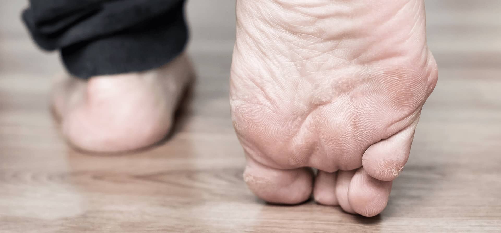 Understand Crooked Toes, Types and Treatment
