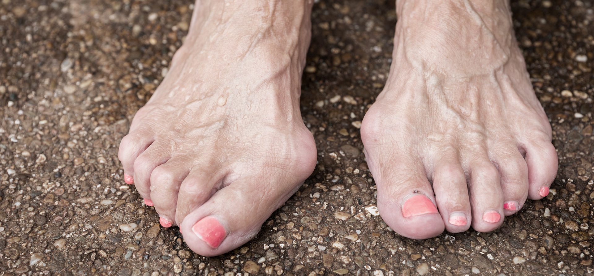 The Best Ways You Can Treat Hammertoe, 59% OFF