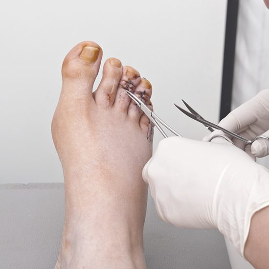 Can Hammertoes Be Dangerous?: Premier Foot and Ankle Center & Elite Upper  Extremity and Plastic Surgery: Podiatry