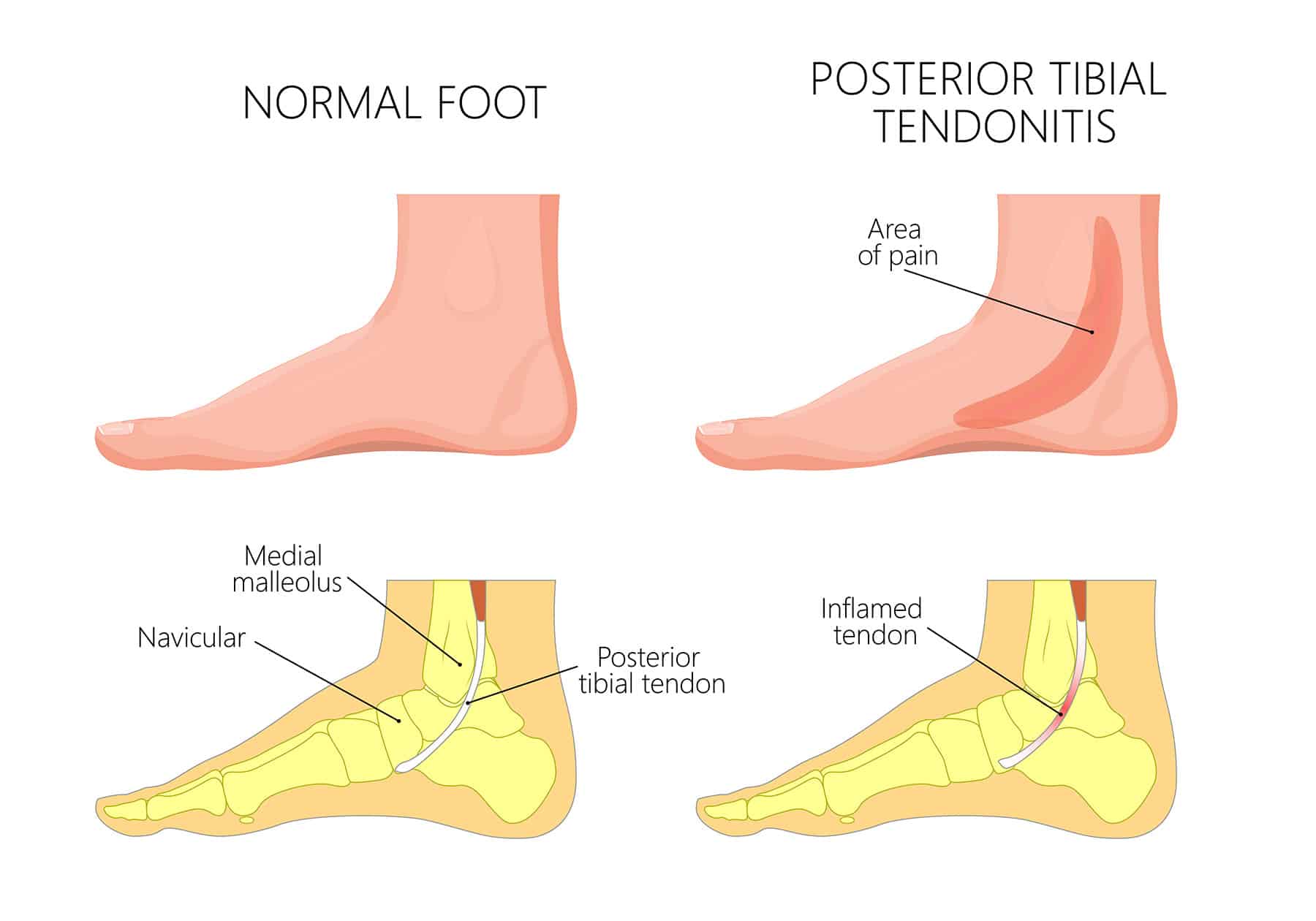 Posterior Tibial Tendonitis - Symptoms, Causes & Treatments